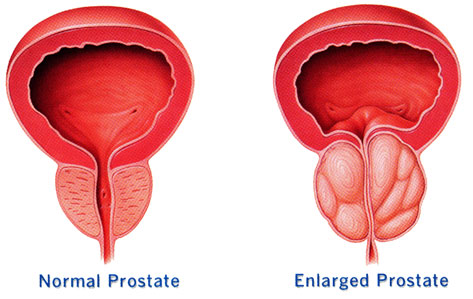Нормальная простата и Воспаленая простата